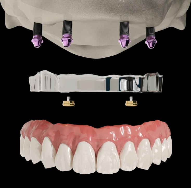 Removable 4