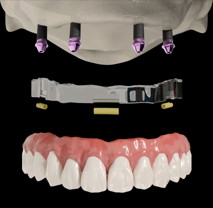 Removable 5