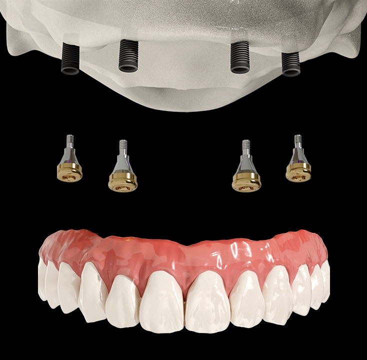 Removable 6